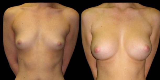 This is a 24-year-old female that has had a breast augmentation and implant showing the before and after's side-by-side
