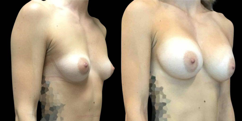 This is a 24-year-old female that has had a breast augmentation and implant showing the before and after's side-by-side