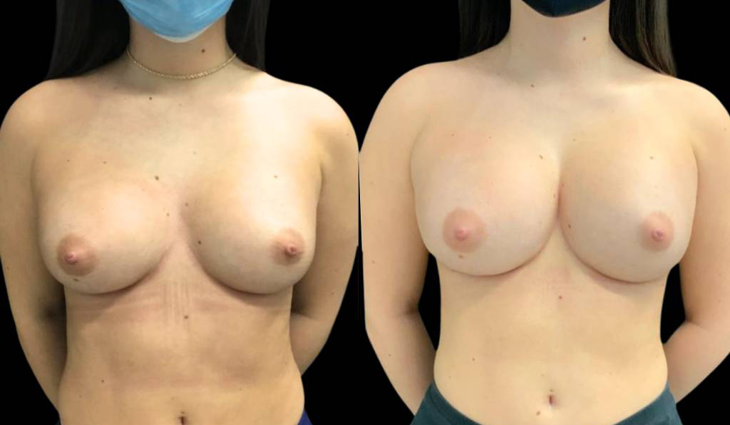 24-year-old-female-breast-implant-exchange-before-and-after-front-view.jpg