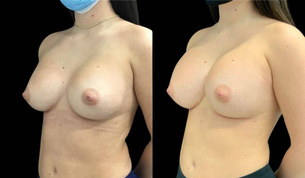 24-year-old-female-breast-implant-exchange-before-and-after-three-quarter-view.jpg