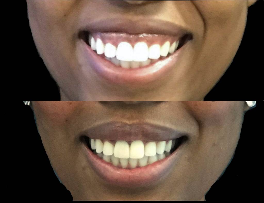 24-year-old-female-gummy-smile-reduction-before-and-after-1