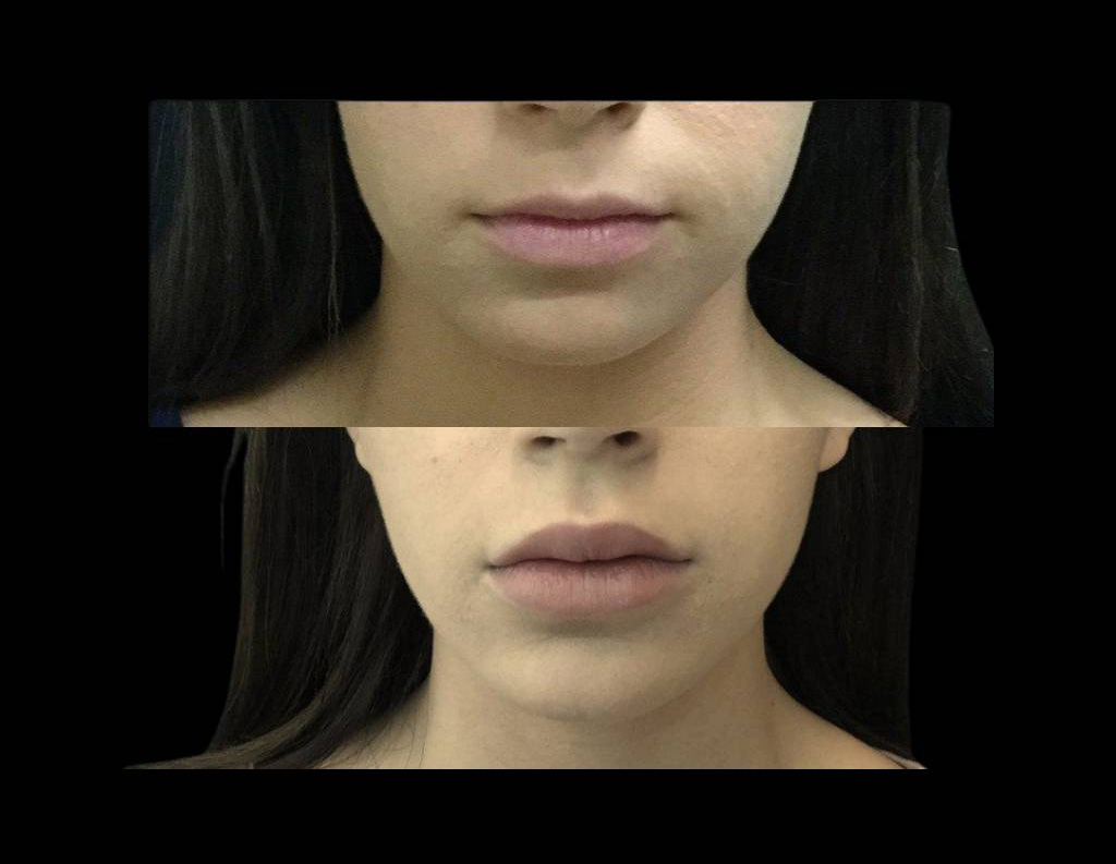 24-year-old-female-juvederm-before-and-after.jpg