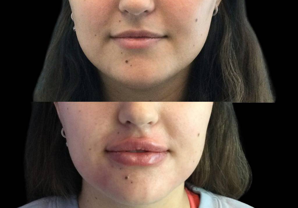 24-year-old-female-lip-augmentation-before-and-after-front-view.jpg