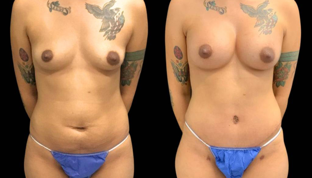 24-year-old-female-mommy-makeover-body-before-and-after-front-view.jpg