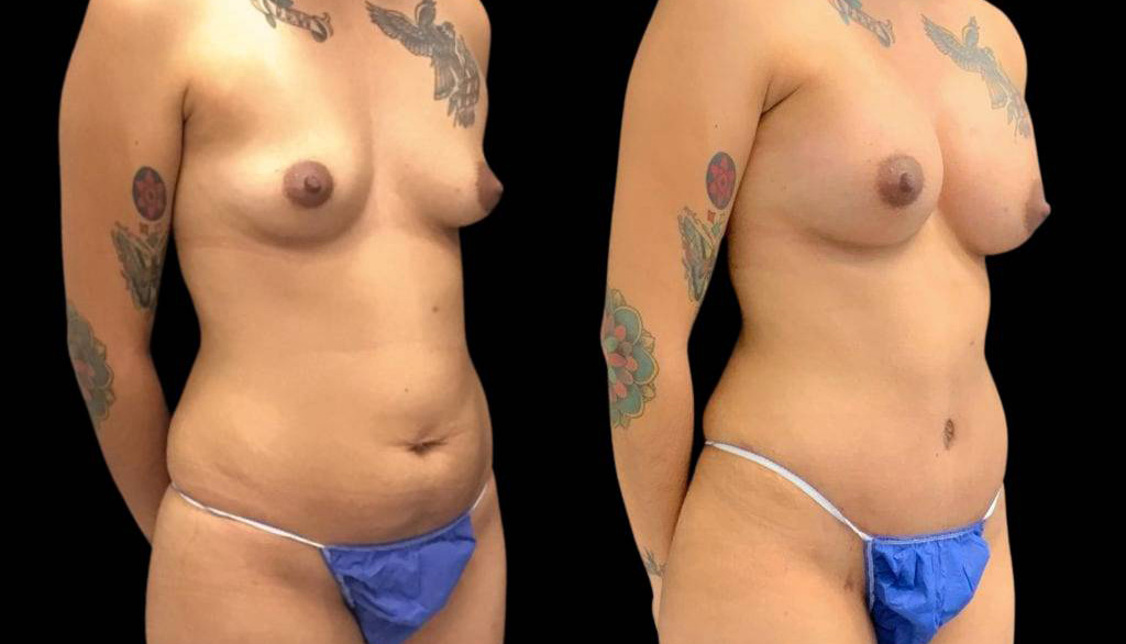 24-year-old-female-mommy-makeover-body-before-and-after-three-quarters-view-32326.jpg