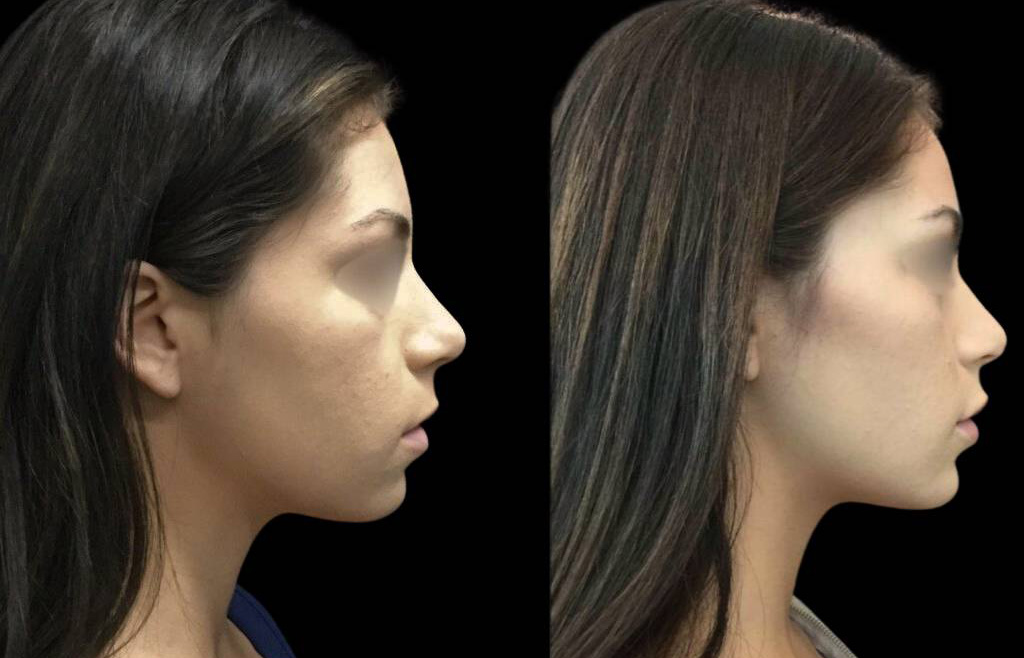 24-year-old-female-non-surgical-chin-augmentation-before-and-after-1.jpg