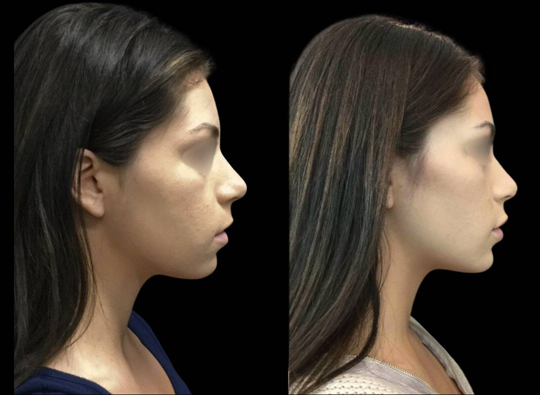 24-year-old-female-non-surgical-chin-augmentation-before-and-after-1.jpg
