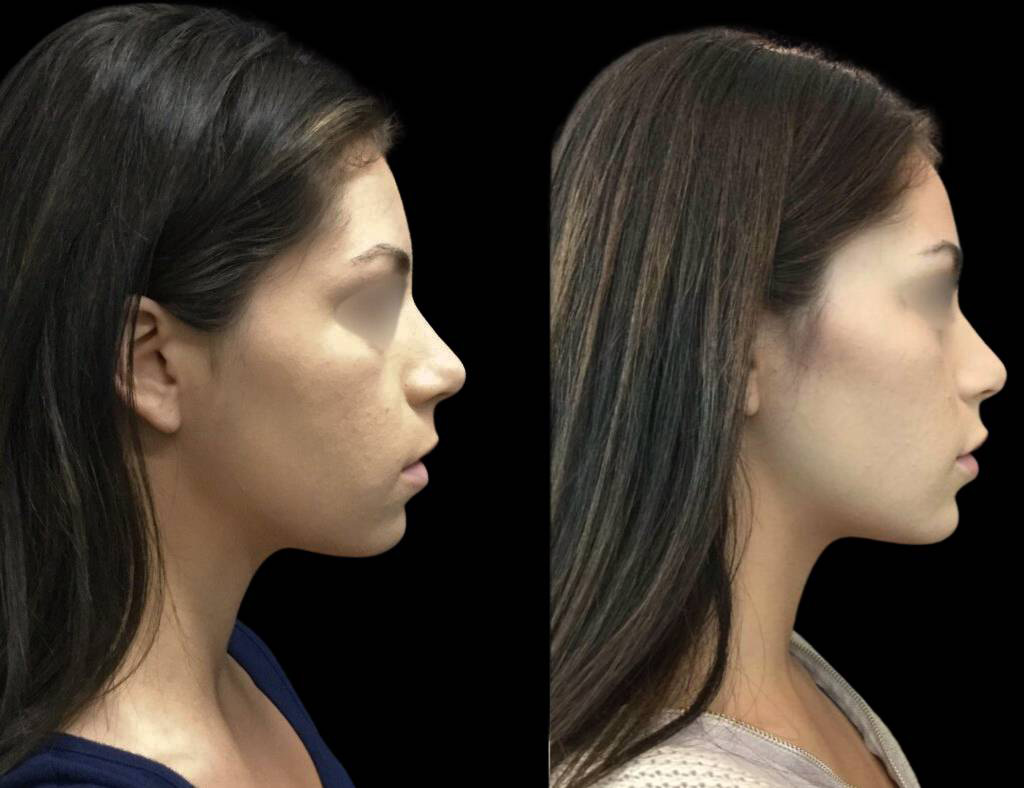 24-year-old-female-non-surgical-chin-augmentation-before-and-after-1.jpg