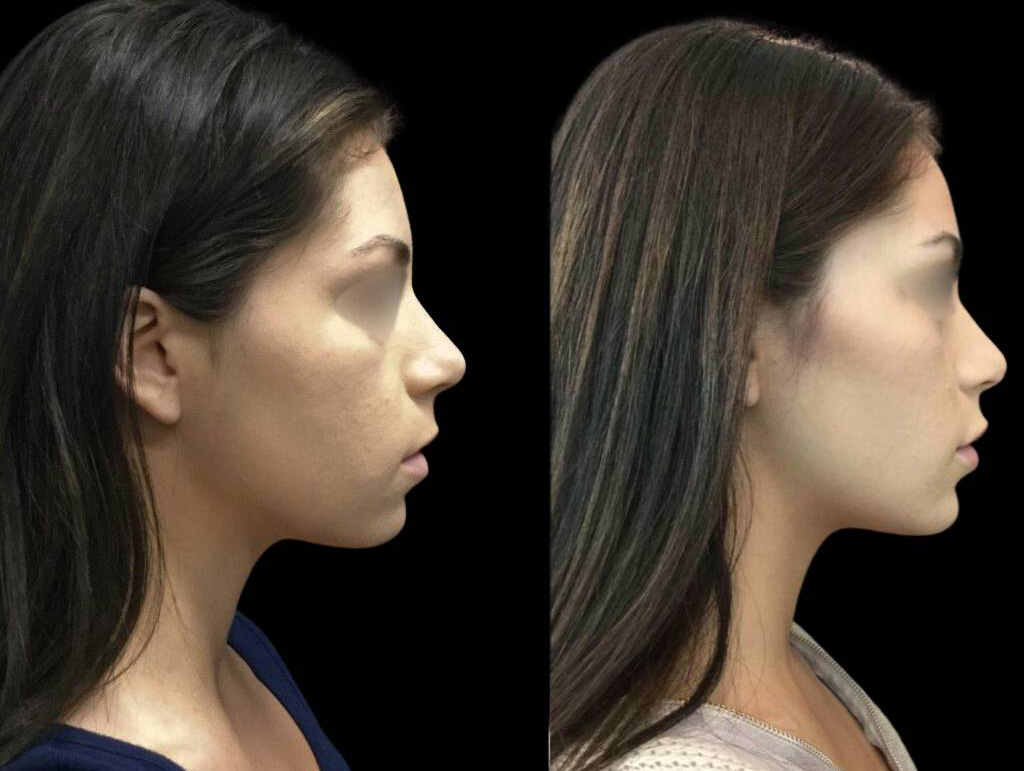 24-year-old-female-non-surgical-chin-augmentation-before-and-after-1.jpg