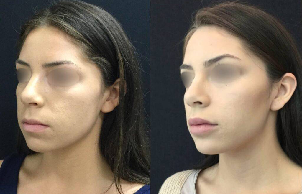 24-year-old-female-non-surgical-chin-augmentation-before-and-after.jpg