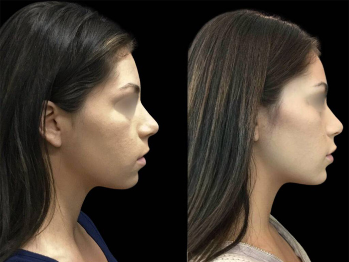 24-year-old-female-non-surgical-chin-augmentation-before-and-after-1.jpg