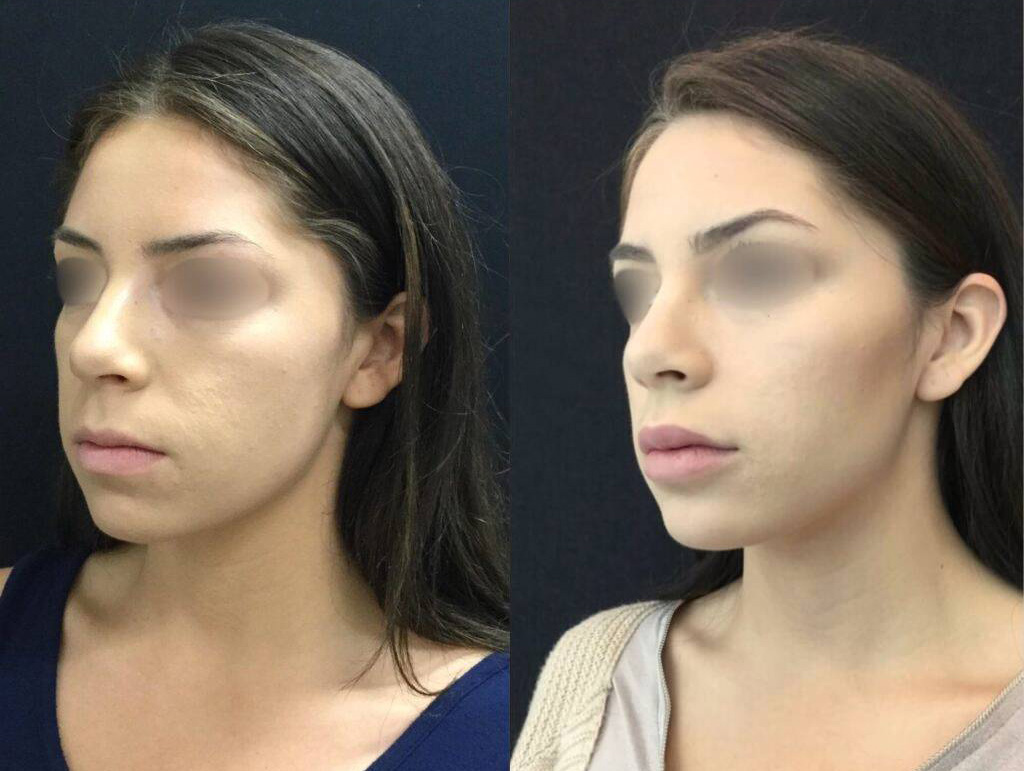 24-year-old-female-non-surgical-chin-augmentation-before-and-after.jpg