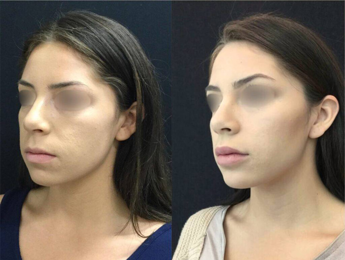 24-year-old-female-non-surgical-chin-augmentation-before-and-after.jpg