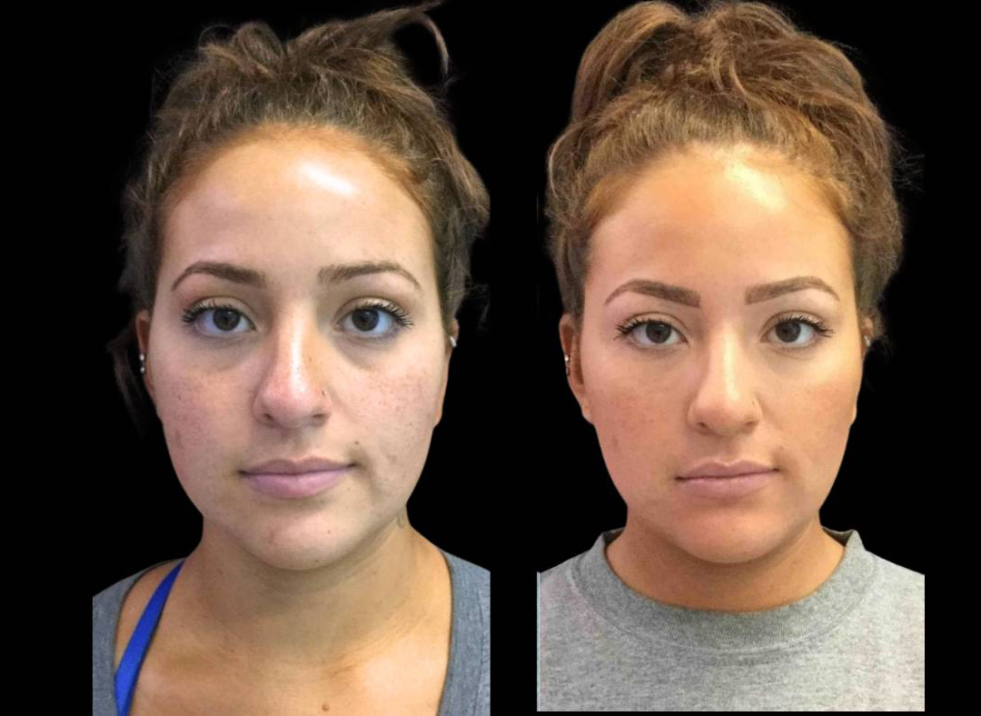 24-year-old-female-restylane-before-and-after-front-view-25122.jpg