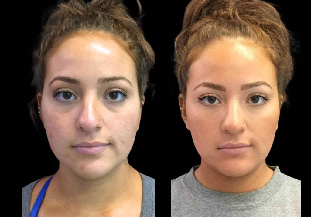 24-year-old-female-restylane-before-and-after-front-view-25122.jpg