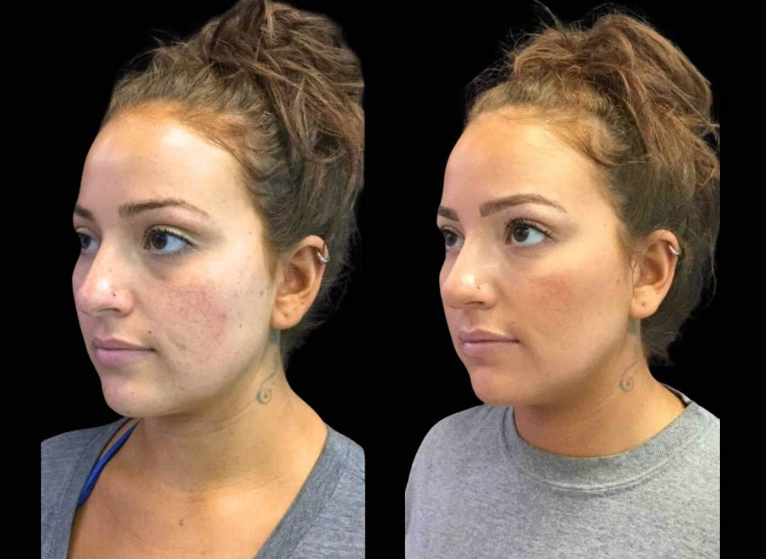 24-year-old-female-restylane-lift-before-and-after-three-quarter-view.jpg