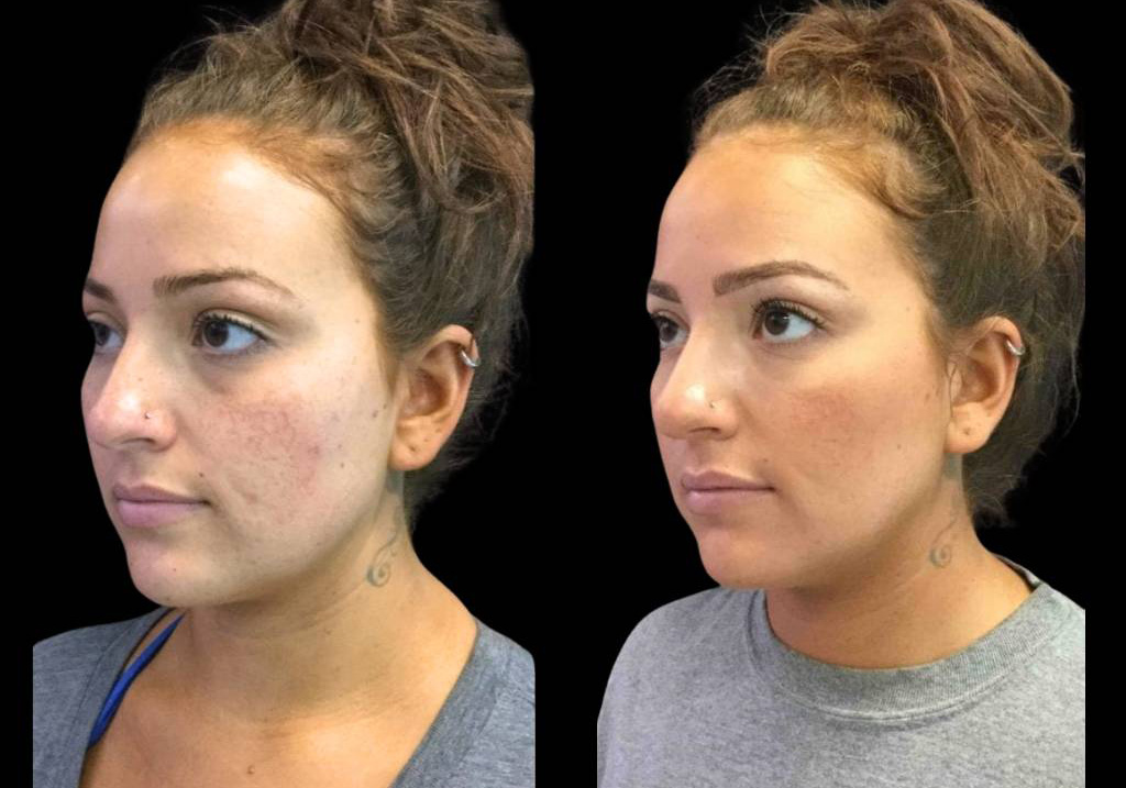 24-year-old-female-restylane-lift-before-and-after-three-quarter-view.jpg