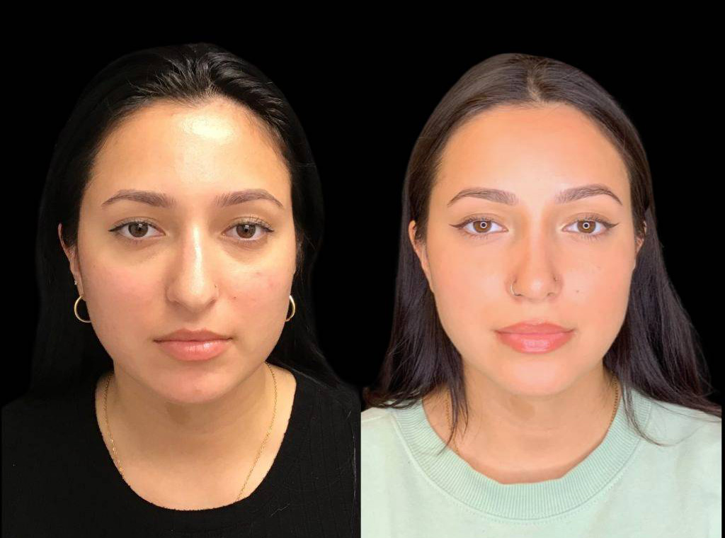 24-year-old-female-rhinoplasty-before-and-after-front-view-.jpg