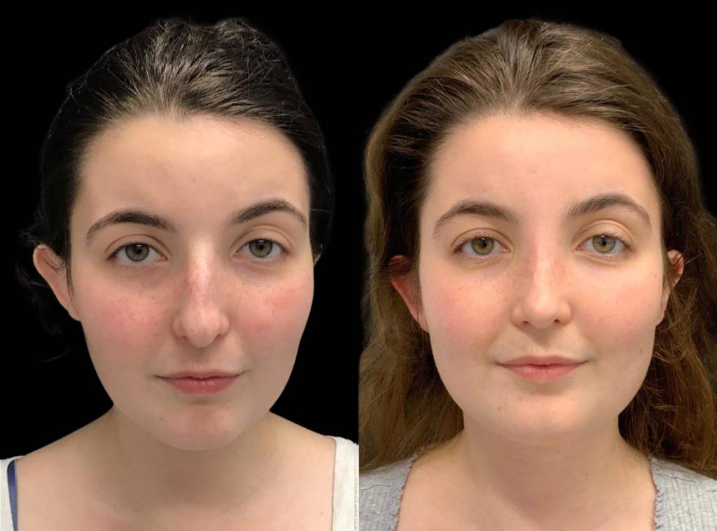 24-year-old-female-rhinoplasty-before-and-after-front-view-1.jpg