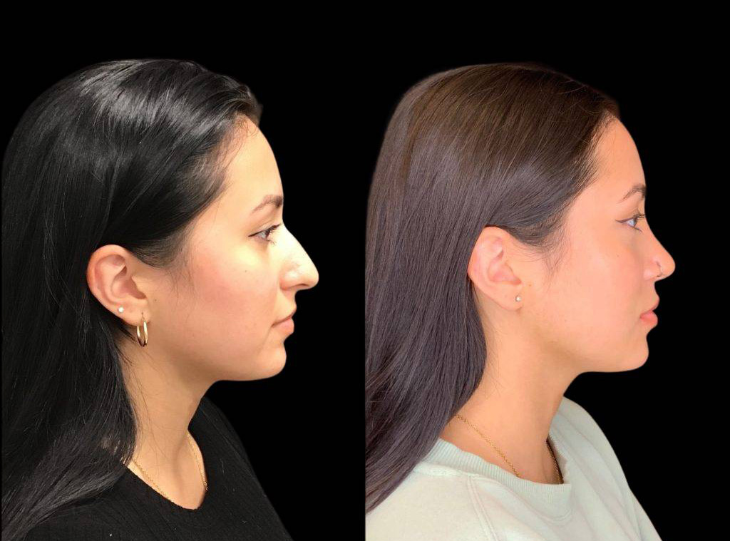 24-year-old-female-rhinoplasty-before-and-after-side-view-1-1.jpg
