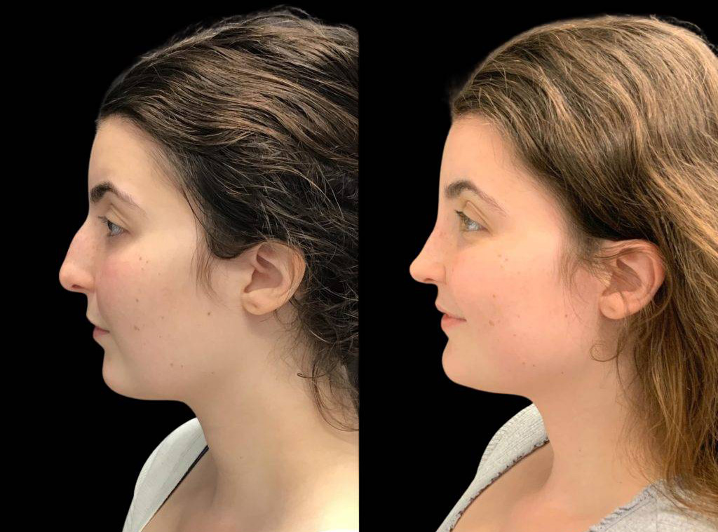 24-year-old-female-rhinoplasty-before-and-after-side-view-1.jpg