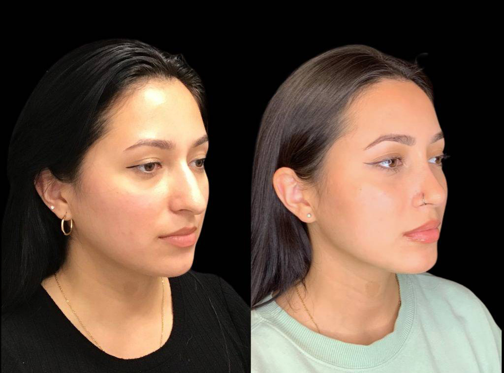 24-year-old-female-rhinoplasty-before-and-after-three-quarters-view-1-1.jpg