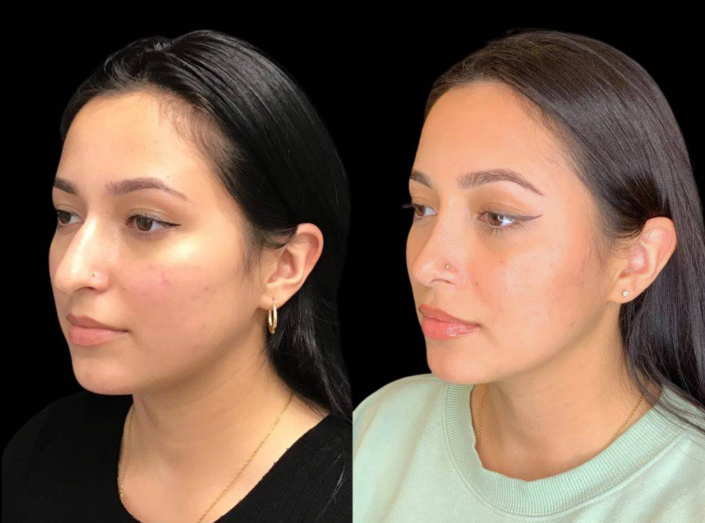 24-year-old-female-rhinoplasty-before-and-after-three-quarters-view-1-2.jpg