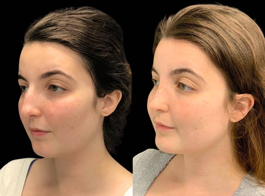 24-year-old-female-rhinoplasty-before-and-after-three-quarters-view-1.jpg