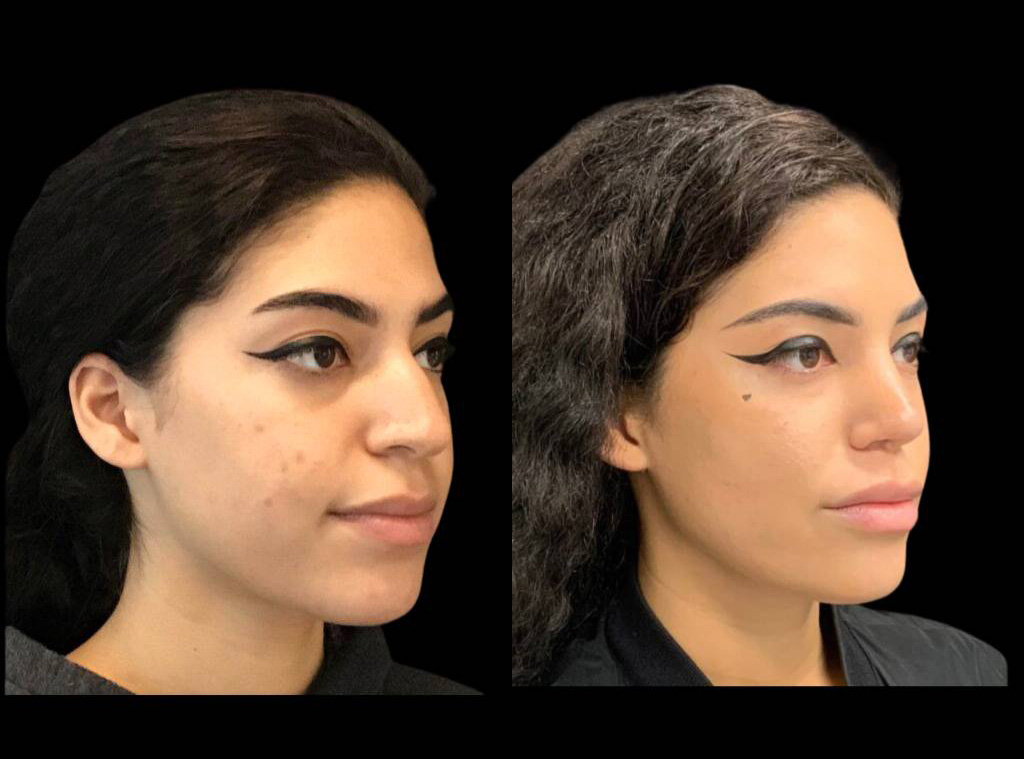 24-year-old-female-rhinoplasty-before-and-after-three-quarters-view-2-2.jpg