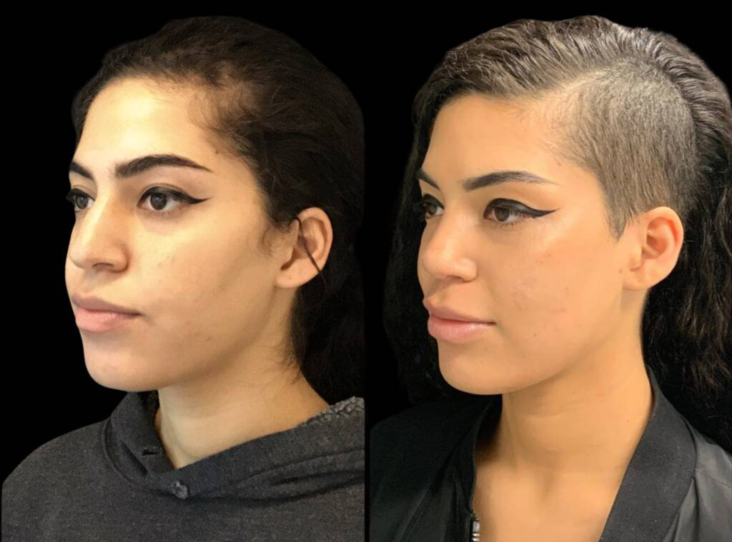 24-year-old-female-rhinoplasty-before-and-after-three-quarters-view-4.jpg