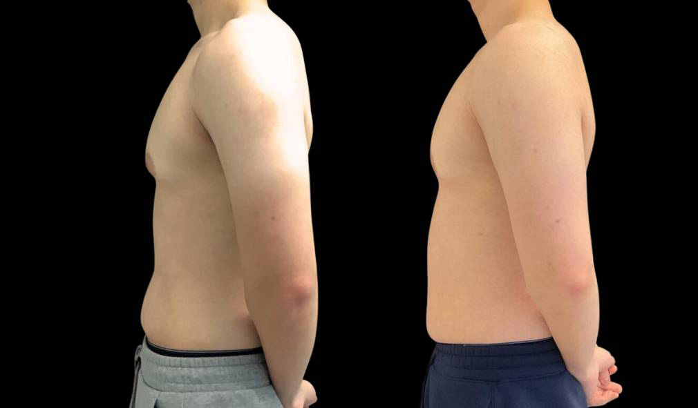24-year-old-male-breast-reduction-before-and-after-front-view-2.jpg