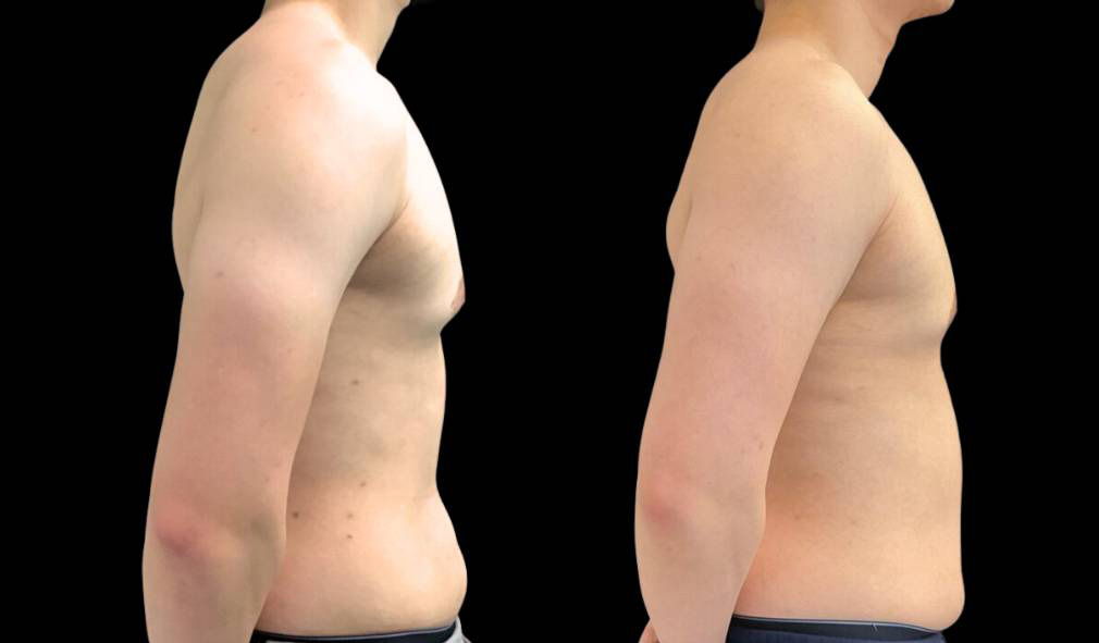 24-year-old-male-breast-reduction-before-and-after-front-view-3.jpg