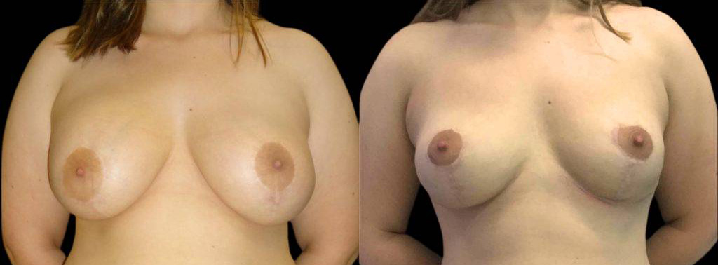This is a 25-year-old female that has had a breast lift showing the before and after's side-by-side