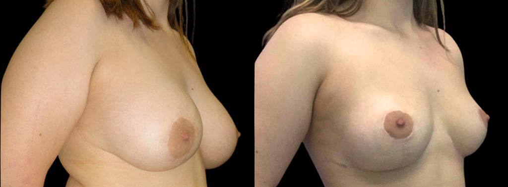 This is a 25-year-old female that has had a breast lift showing the before and after's side-by-side