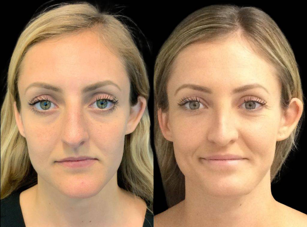 25-year-old-female-rhinoplasty-before-and-after-front-view-1.jpg