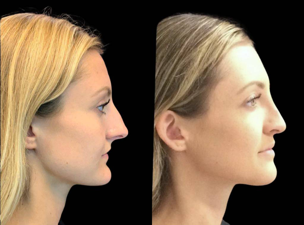 25-year-old-female-rhinoplasty-before-and-after-side-view-4.jpg