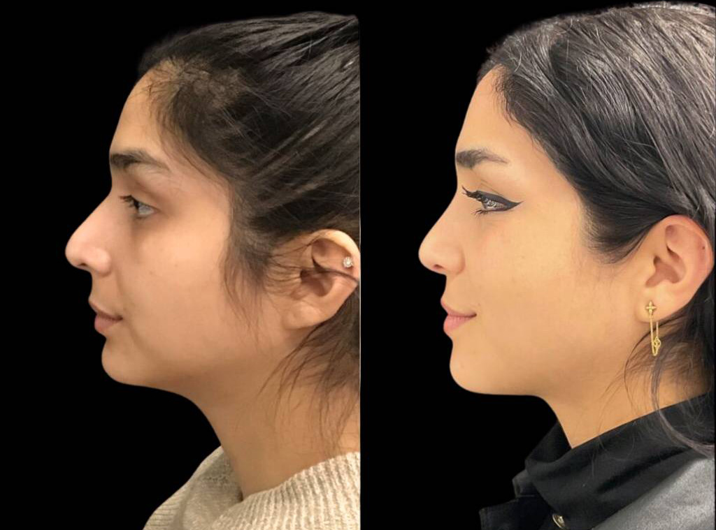 25-year-old-female-rhinoplasty-before-and-after-side-view-5.jpg