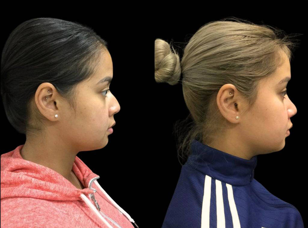 25-year-old-female-rhinoplasty-before-and-after-side-view.jpg