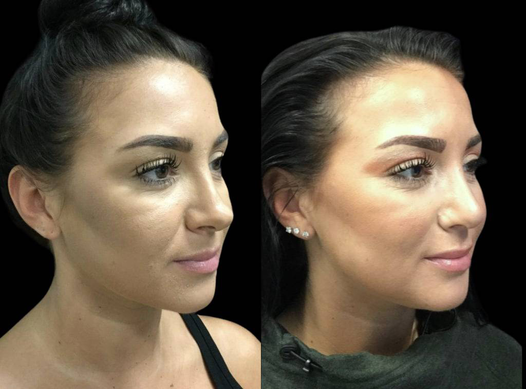 25-year-old-female-rhinoplasty-before-and-after-three-quarters-view-1.jpg