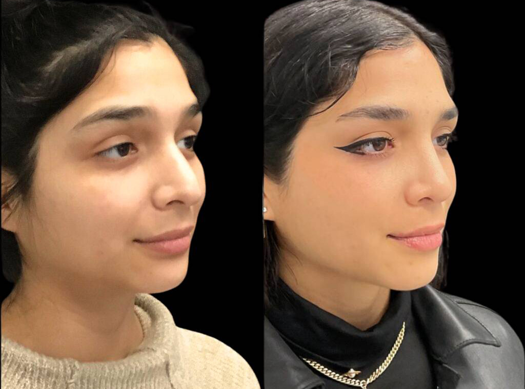 25-year-old-female-rhinoplasty-before-and-after-three-quarters-view-2-1.jpg