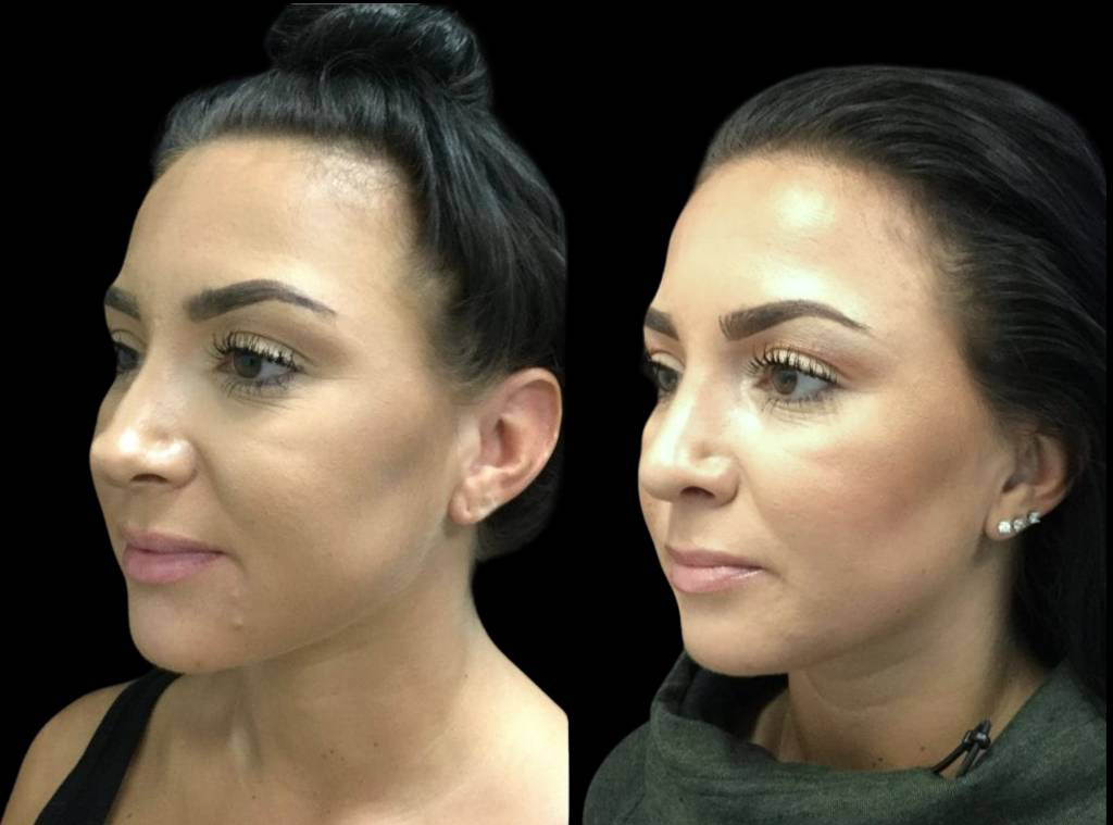 25-year-old-female-rhinoplasty-before-and-after-three-quarters-view-2.jpg