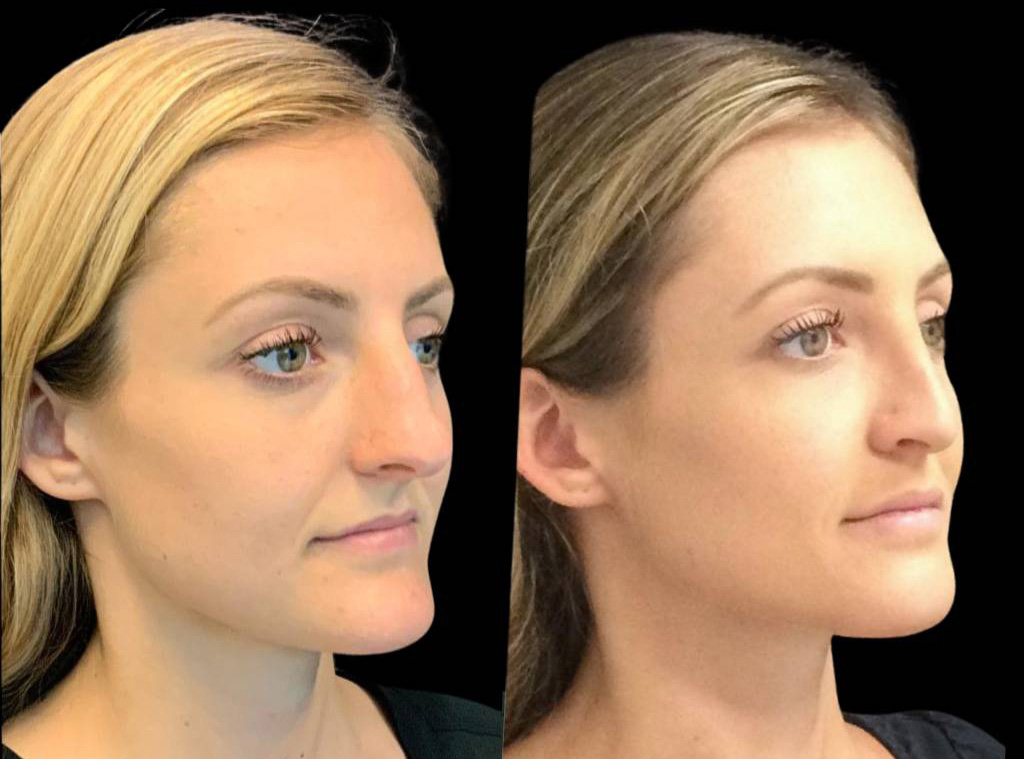 25-year-old-female-rhinoplasty-before-and-after-three-quarters-view-5.jpg