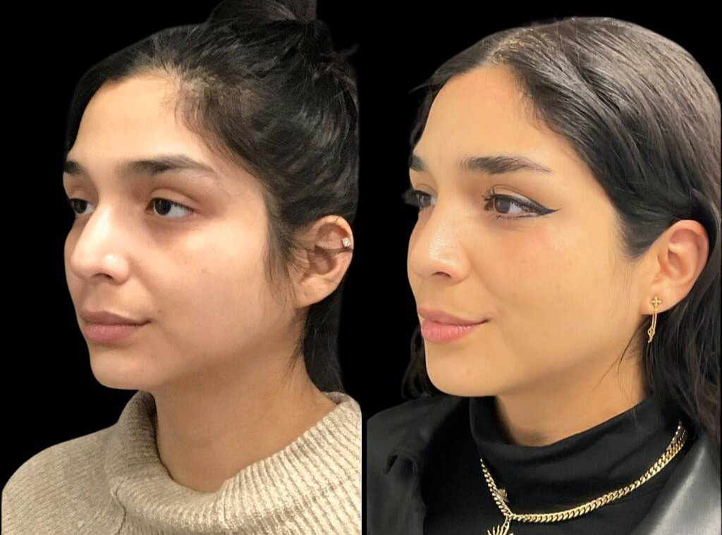 25-year-old-female-rhinoplasty-before-and-after-three-quarters-view-6.jpg