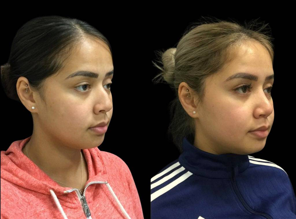 25-year-old-female-rhinoplasty-before-and-after-three-quarters-view.jpg