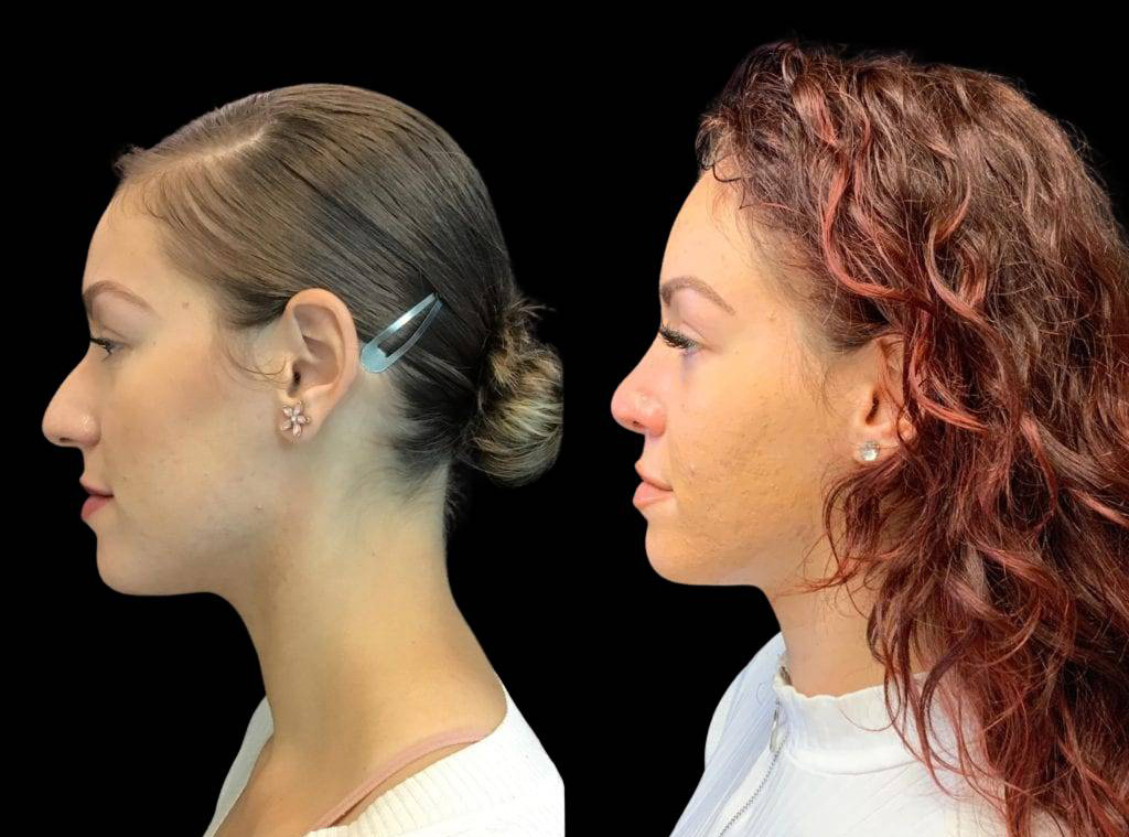 25-year-old-female-rhinoplasty-side-view.jpg
