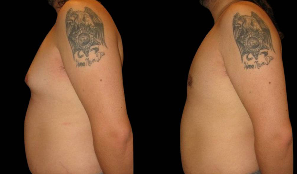 25-year-old-male-breast-reduction-before-and-after-side-view-12713.jpg