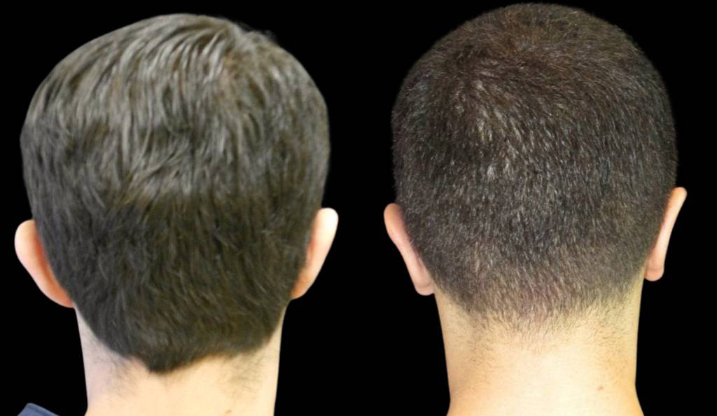 25-year-old-male-ear-pinning-before-and-after-back-view.jpg