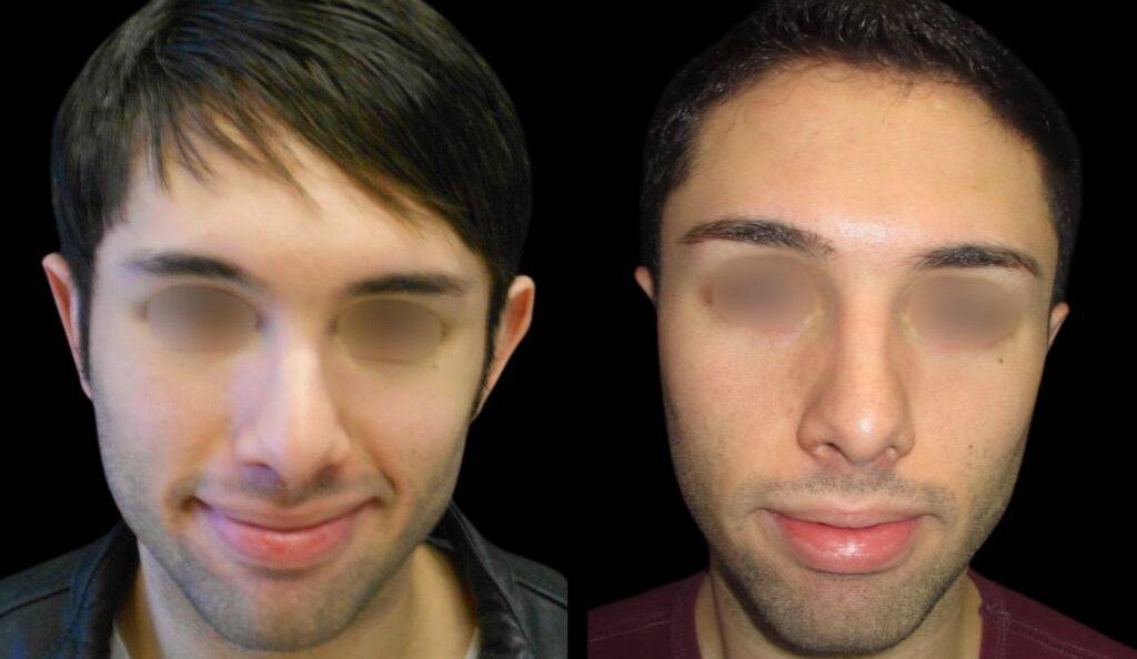 25-year-old-male-ear-pinning-before-and-after-front-view.jpg