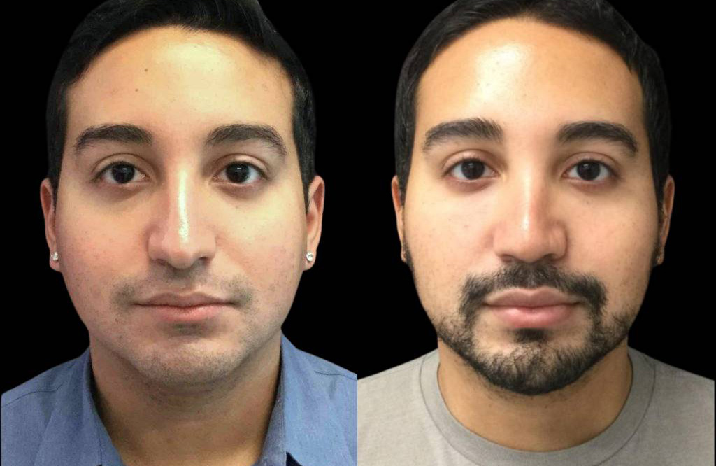 25-year-old-male-rhinoplasty-before-and-after-front-view-2.jpg