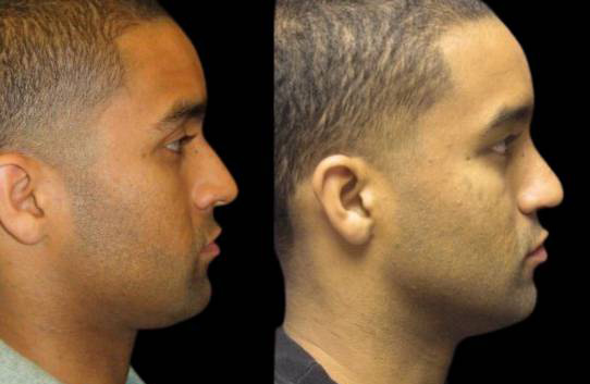 25-year-old-male-rhinoplasty-before-and-after-side-view-3.jpg